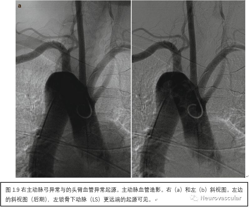 脑血管造影读片基础图谱颈内动脉颈外动脉主动脉弓图谱