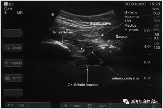 骶丛;sacrum:骶骨;gr sciatic foramen:坐骨大孔;inferior gluteal