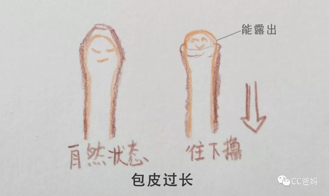                     男宝宝包皮要不要割？这几种情况千万别大意！