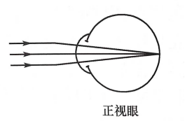 首先了解下什么是正视眼:眼在休息时,平行光经过眼屈光系统的屈光作用