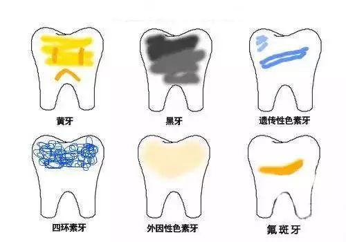 内源性着色 在牙齿发育过程中形成的,如四环素沉积在牙本质内,就会