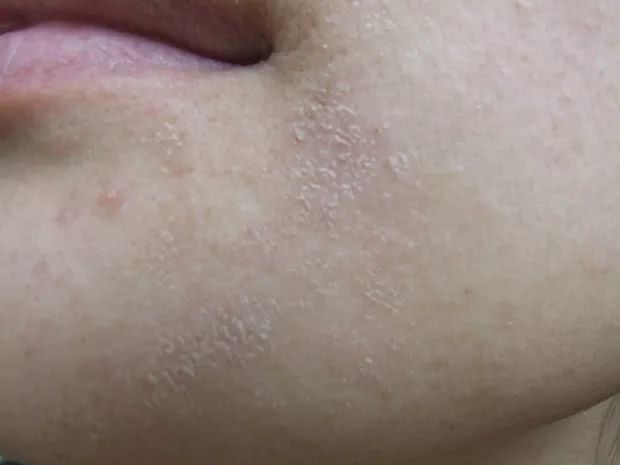 脸部干燥严重的话,会起 红斑,并伴随 口,鼻四周皮肤脱落现象,十分刺痒