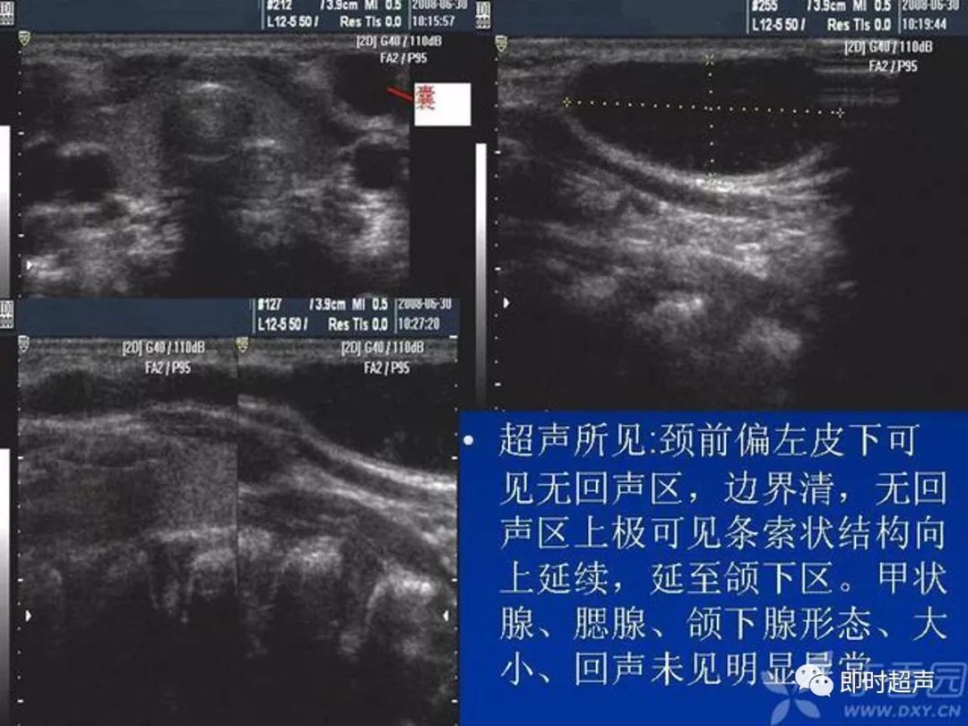 体表肿物的超声诊断与鉴别