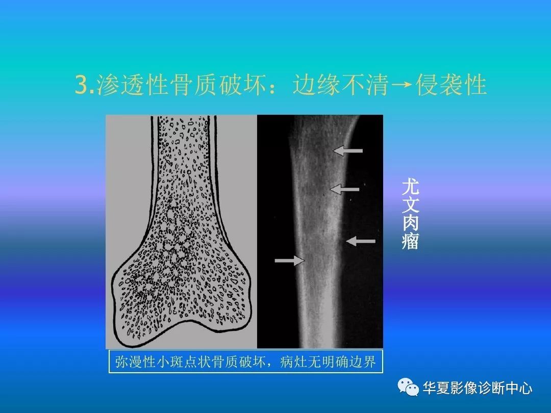 影像基础骨肿瘤肿瘤样病变的影像诊断及策略