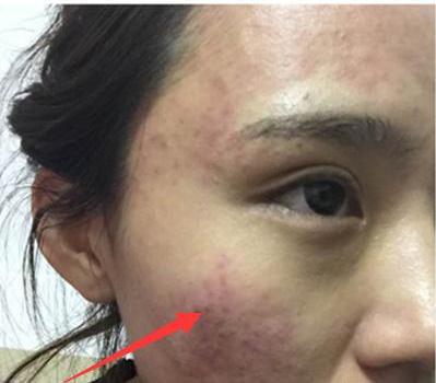 患有湿疹脸部瘙痒千万别挠教你一招轻松击败