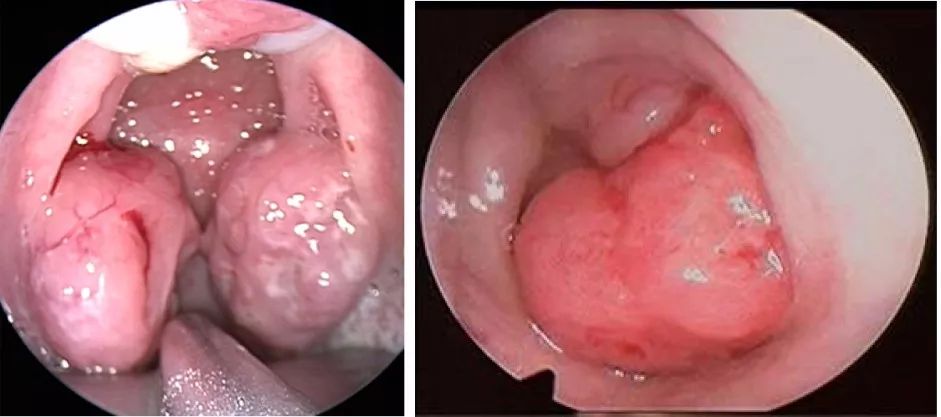 扁桃体肥大(左) 腺样体肥大(右)