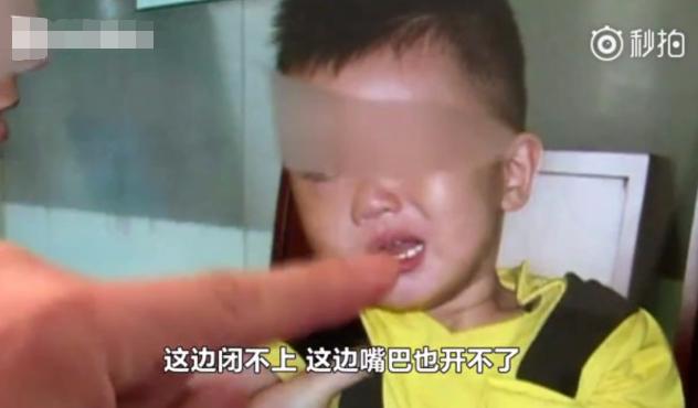                      2岁男童成面瘫，儿科医生：夏季带娃，别做3件事，实在坑孩子