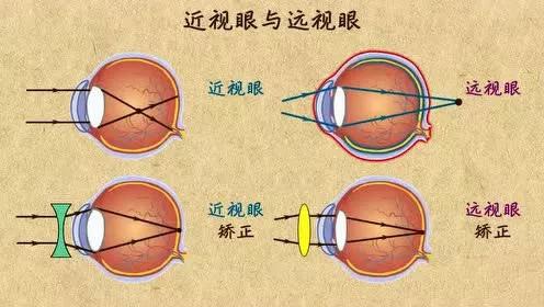 近视和远视多是由于眼球前后径过长或过短造成,而老花眼则是晶状体和