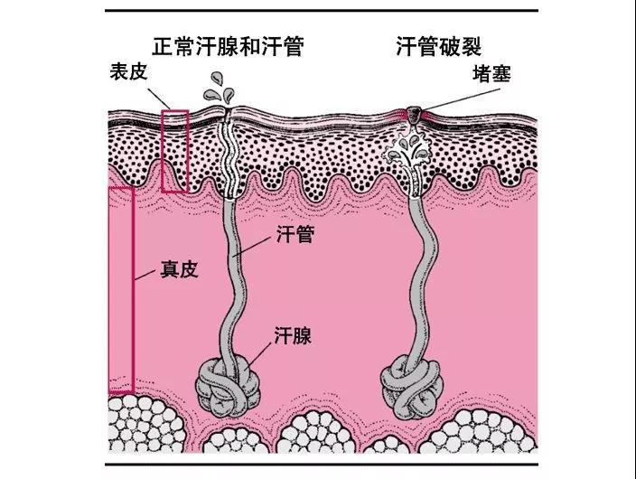                     水晶痱、红痱、脓痱，不同痱子护理方法大不同，妈妈要学会分辨