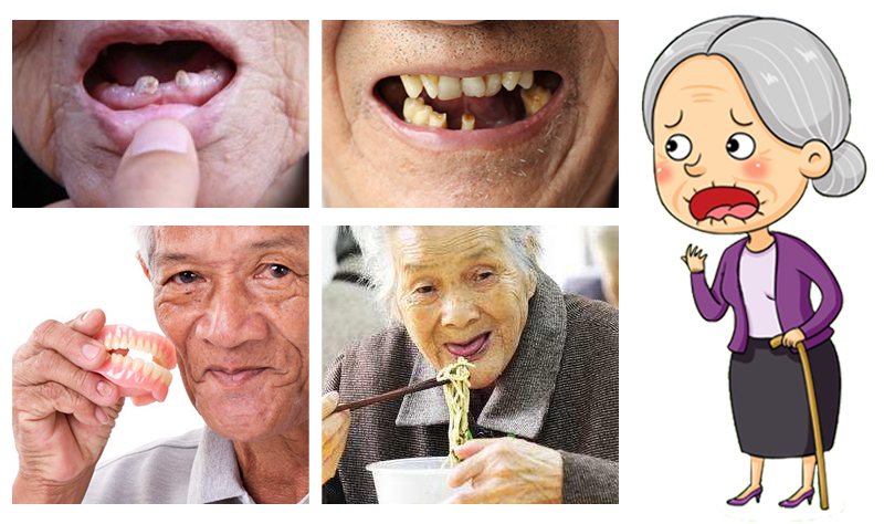 8成缺牙中老年人的真实写照咬不动,嚼不烂,吃不