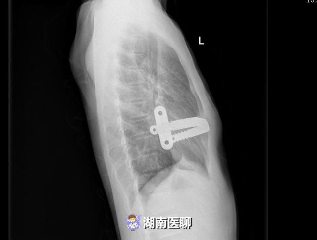 16岁少年先天漏斗胸住院到出院只用一天期间完全不插管