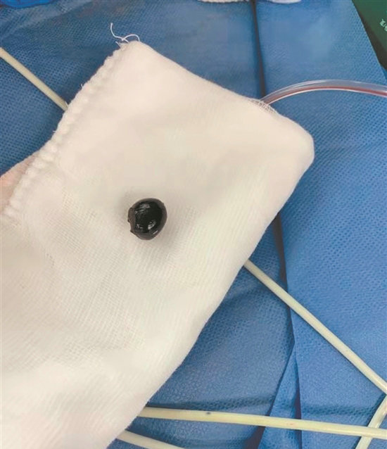                     一颗龙眼核卡幼童食管3年 小心幼儿误食异物，发现异常及时就医