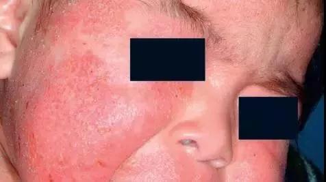                     水晶痱、红痱、脓痱，不同痱子护理方法大不同，妈妈要学会分辨