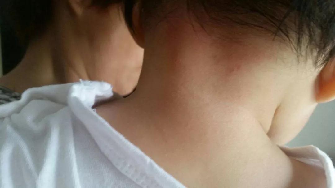                     水晶痱、红痱、脓痱，不同痱子护理方法大不同，妈妈要学会分辨