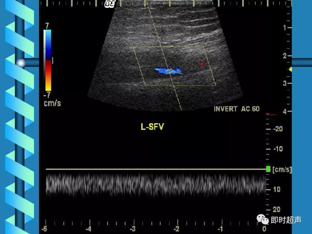 下肢深静脉血栓的超声诊断
