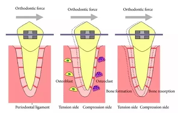 正畸牙齿移动的原理_正畸中牙齿移动的原理