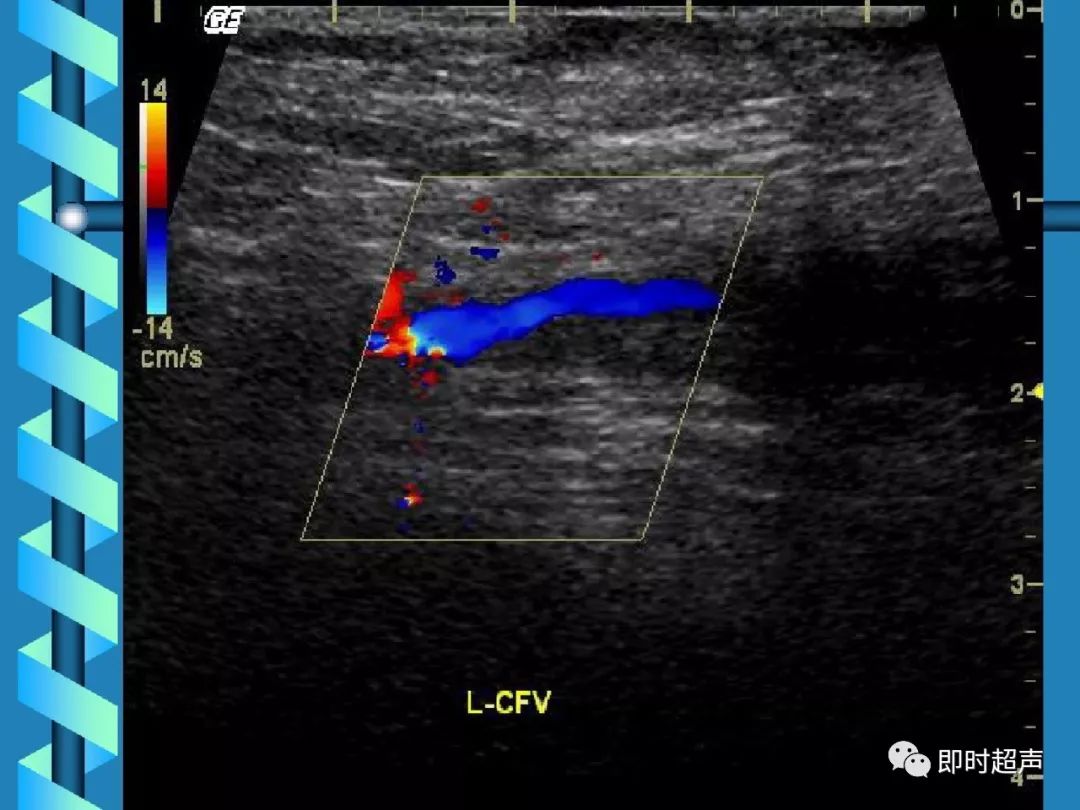 下肢深静脉血栓的超声诊断