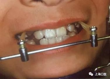 前方牵引器矫治替牙期反合案例组图原创