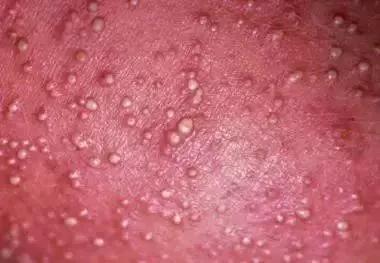                     水晶痱、红痱、脓痱，不同痱子护理方法大不同，妈妈要学会分辨