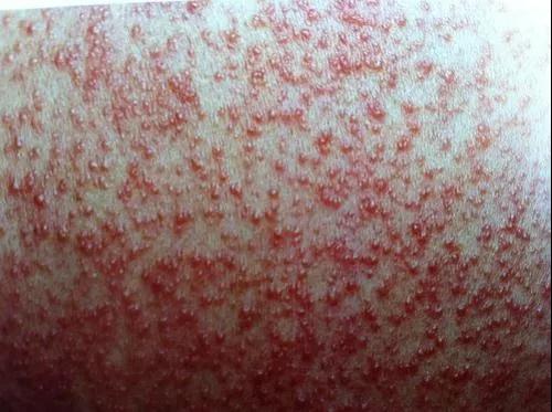                     水晶痱、红痱、脓痱，不同痱子护理方法大不同，妈妈要学会分辨