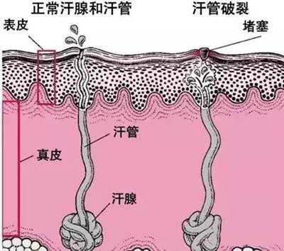                     宝宝夏季全身长痱子，一定要慎用痱子粉！不能敷衍了事...