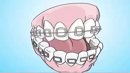 牙齿矫正期间如何刷牙更好?戳这里!