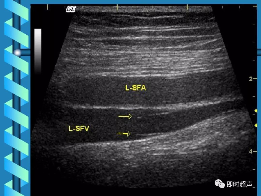 下肢深静脉血栓的超声诊断