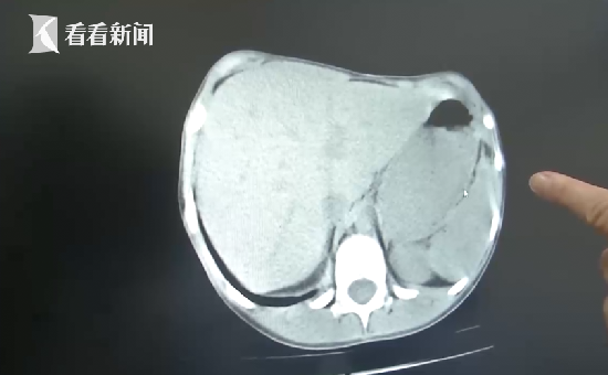                     妈妈往沙发上扔了个手机 竟害得女儿脾脏被摘除