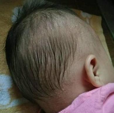                     孩子爱出汗是因为缺钙？医生：八杆子打不着，主要是这3个原因