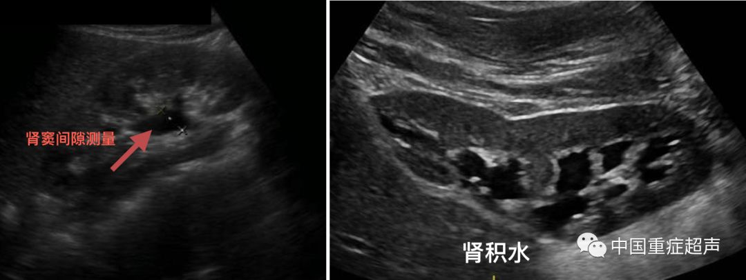 跬步千里throughtues重症超声规范6重症肾脏超声的获取与解读