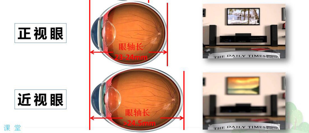 近视眼又和正常眼睛有什么不同呢?