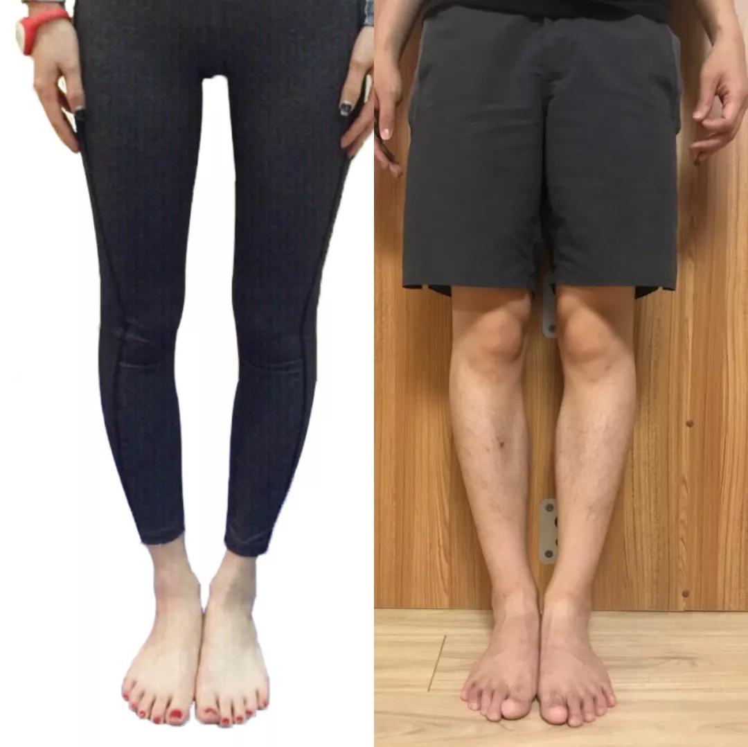 长腿小姐姐的5天o型腿矫正案例