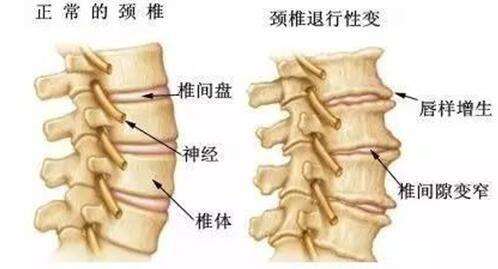 骨质增生腰疼怎么办