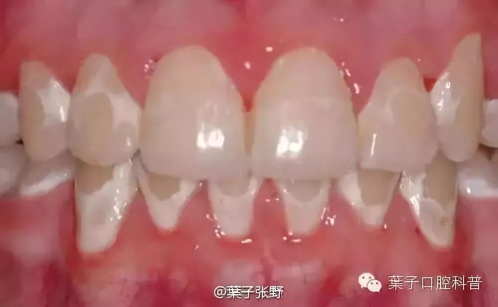 也有很多人把脱矿称之为脱钙,因为在这个脱矿的过程中,牙釉质的钙离子