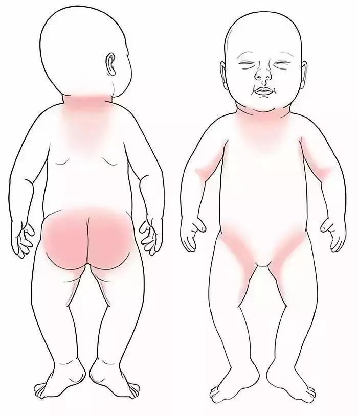                     水晶痱、红痱、脓痱，不同痱子护理方法大不同，妈妈要学会分辨