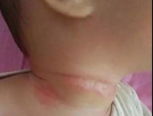                     水晶痱、红痱、脓痱，不同痱子护理方法大不同，妈妈要学会分辨