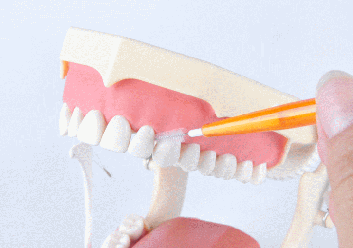 成都正畸医生告诉你：牙齿矫正期间应该如何正确预防蛀牙？