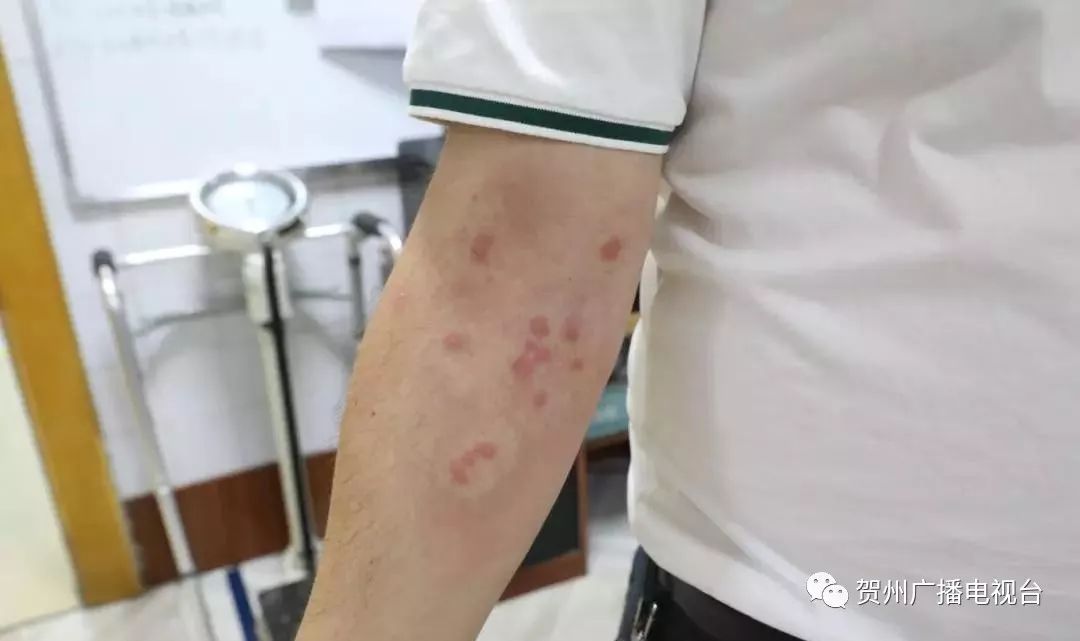 出现了过敏性休克 ▲宗先生 7月5日下午 宗先生在野外被红蚂蚁蜇咬 一