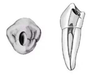 根管治疗图解:6种开髓位置及洞型