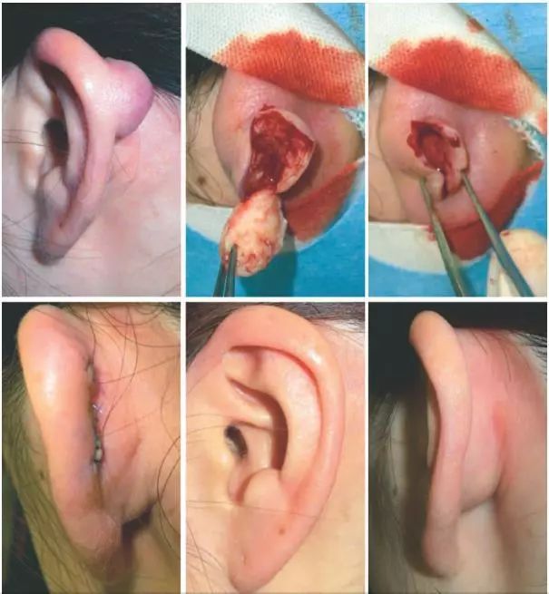 耳部瘢痕疙瘩: 如何治疗?