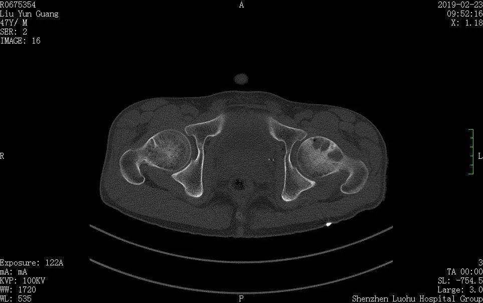 探究ct与核磁共振诊断股骨头坏死患者临床对比