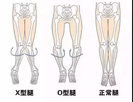 o型腿看过来这里有一份矫正指南请您查看