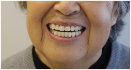 79岁老人看牙经历:不敢拔牙,不想种牙,不戴挂钩牙,怎么修复?