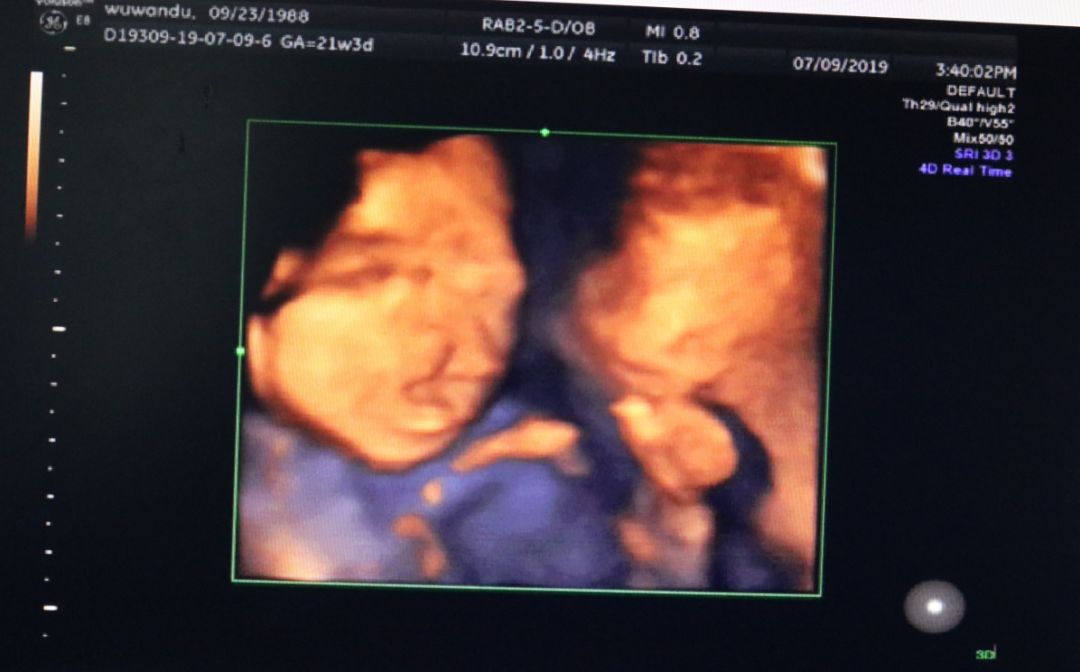 "盲目自信"的二胎妈妈,产检却查出胎儿唇腭裂.
