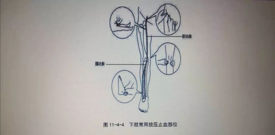 (10)小腿出血:在腘窝中部压迫腘动脉止血.