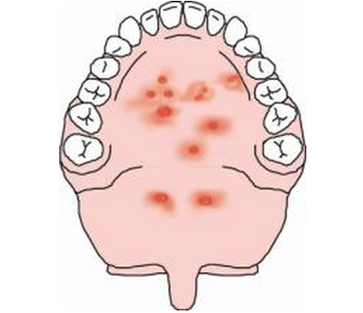 5种常见的口腔疾病不可轻视一旦发现及早治疗