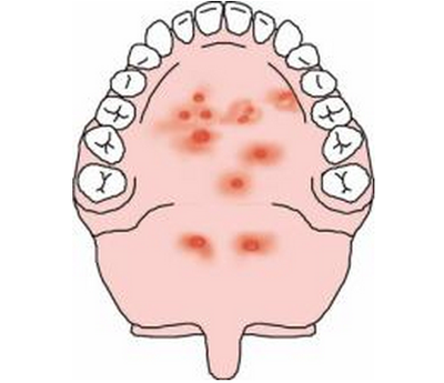 4,疱疹性口腔炎