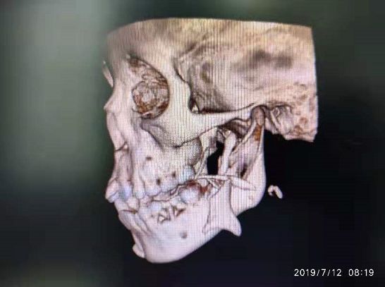                     因这个动作，南宁8岁小男孩面部严重撕裂，暑假安全不容忽视...【930新闻眼】