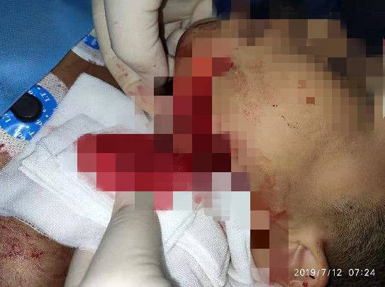                     因这个动作，南宁8岁小男孩面部严重撕裂，暑假安全不容忽视...【930新闻眼】
