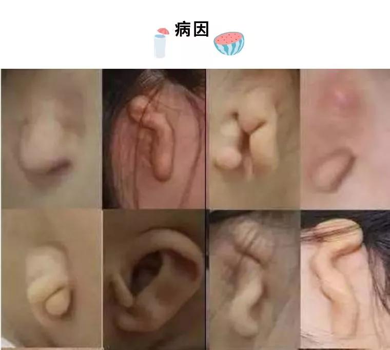 先天性中外耳畸形的听力干预(一)